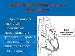 Малий дефект міжшлуночкової
           перегородки

   При наявності
отвору між
шлуночками
велика кількість
артеріальної крові з
лівих відділів серця
скидається через
нього в праві.
 