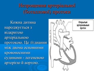 Незрощення артеріальної
        (боталлової) протоки
   Кожна дитина
народжується з
відкритою
артеріальною
протокою. Це з'єднання
між двома основними
кровоносними
судинами - легеневою
артерією й аортою.
 