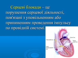 Серцеві блокади – це
порушення серцевої діяльності,
пов'язані з уповільненням або
припиненням проведення імпульсу
по провідній системі.
 