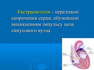 Екстрасистоли - передчасні
скорочення серця, обумовлені
виникненням імпульсу поза
синусового вузла.
 