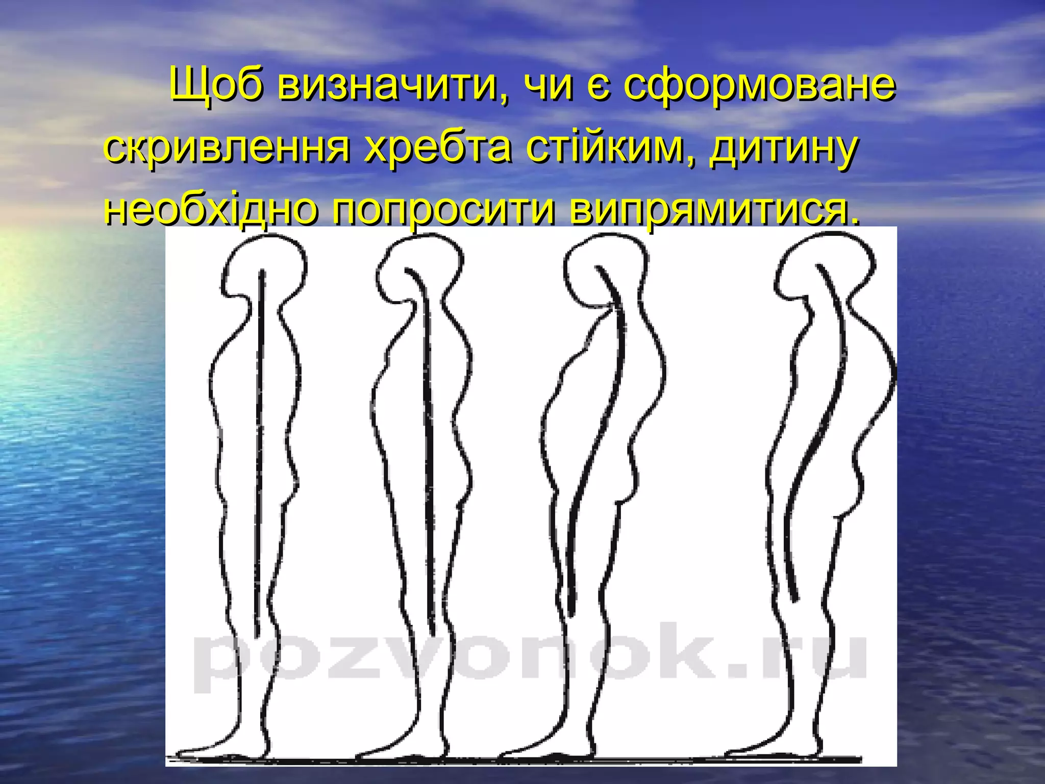 Щоб визначити, чи є сформоване
скривлення хребта стійким, дитину
необхідно попросити випрямитися.
 