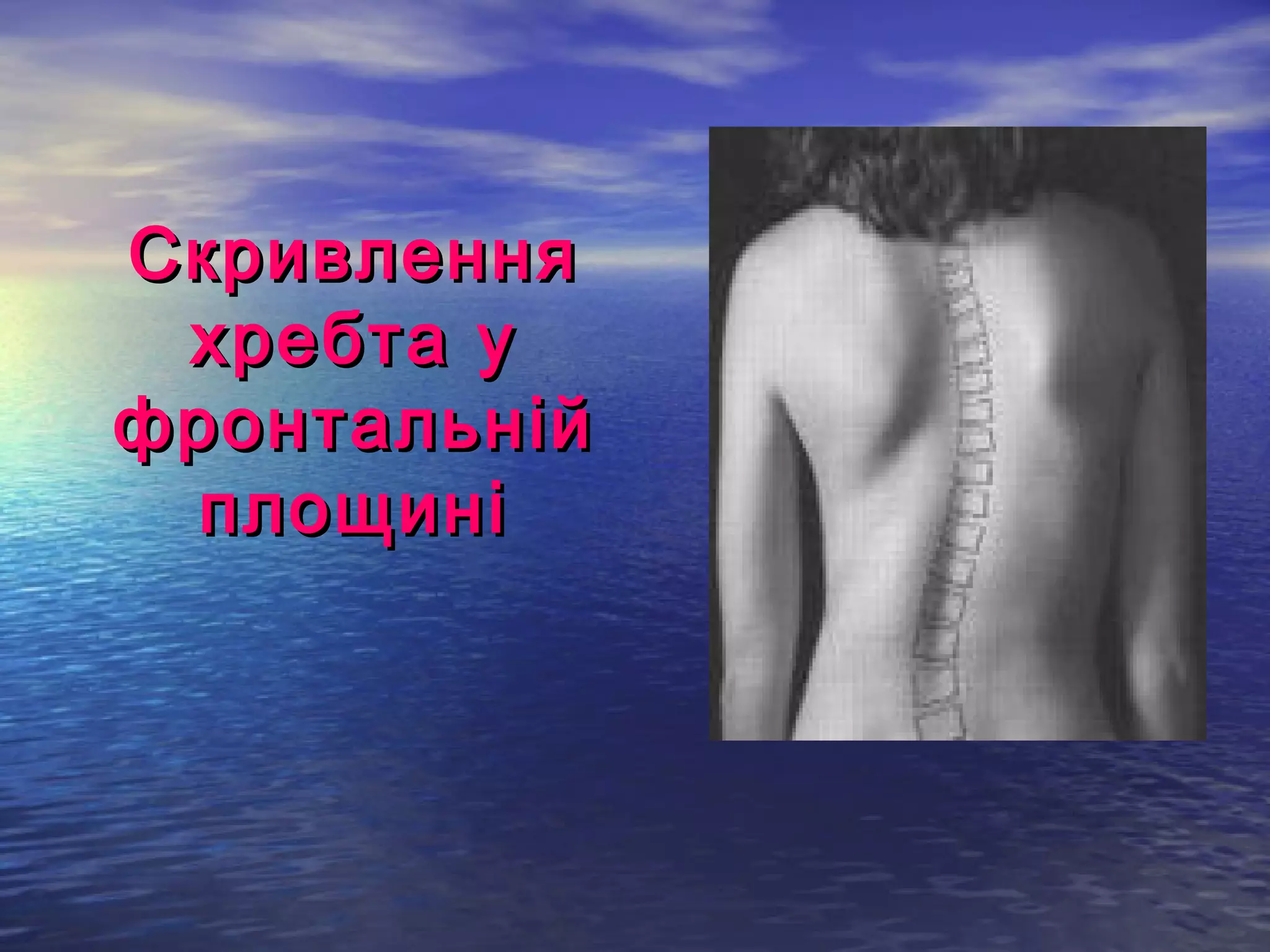 Скривлення
 хребта у
фронтальній
 площині
 