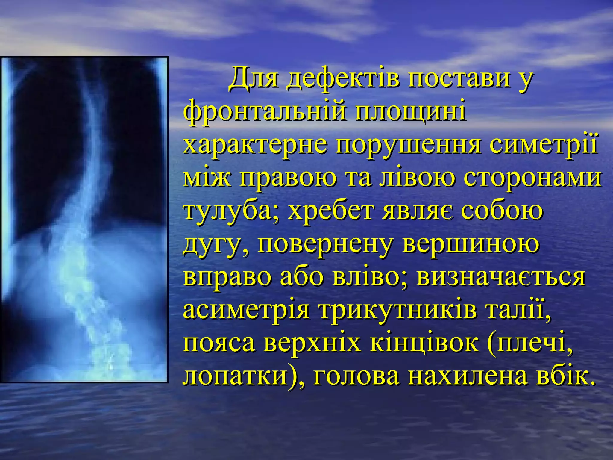Для дефектів постави у
фронтальній площині
характерне порушення симетрії
між правою та лівою сторонами
тулуба; хребет являє собою
дугу, повернену вершиною
вправо або вліво; визначається
асиметрія трикутників талії,
пояса верхніх кінцівок (плечі,
лопатки), голова нахилена вбік.
 