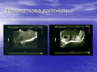 Позаматкова вагітність
 