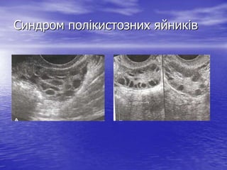 Синдром полікистозних яйників
 