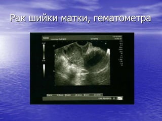Рак шийки матки, гематометра
 