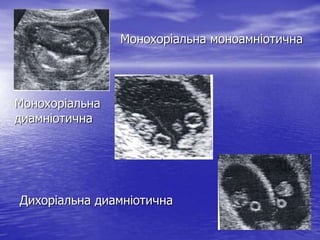 Монохоріальна моноамніотична




Монохоріальна
диамніотична




Дихоріальна диамніотична
 