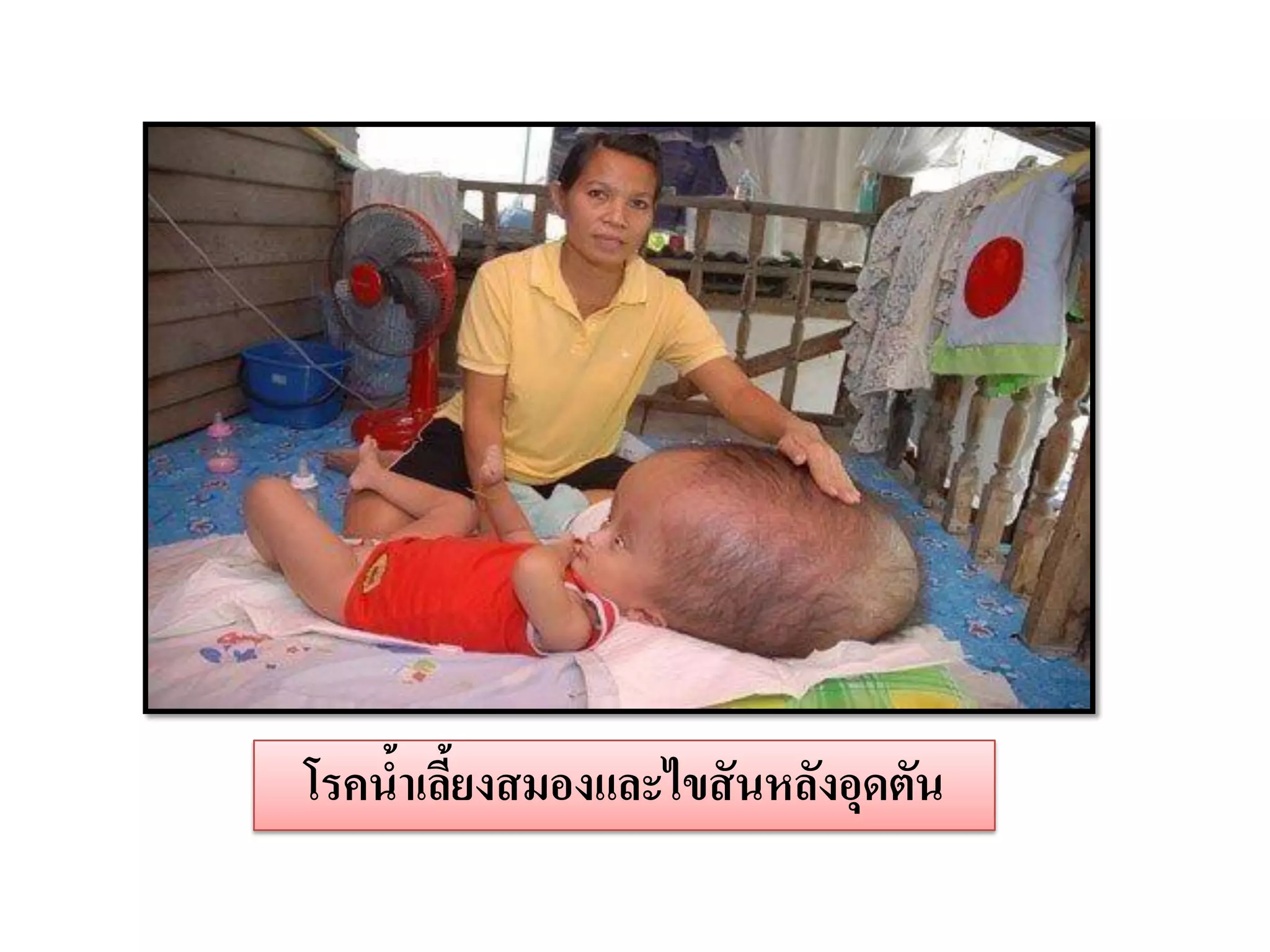 โรคนาเลียงสมองและไขสั นหลังอุดตัน
    ้ ้
 
