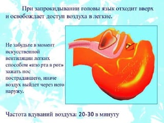 реанимация