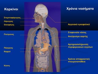 Καρκίνοι          Χρόνια νοσήματα

Στοματοφάρυγγας
Λάρυγγας
Οισοφάγος         Αγγειακό εγκεφαλικό


                  Στεφανιαία νόσος
Πνεύμονας
                  Ανεύρυσμα αορτής


                  Αρτηριοσκλήρυνση
Πάγκρεας          περιφερειακών αγγείων

Νεφροί


                  Χρόνια αποφρακτική
                  πνευμονοπάθεια
Κύστη
 