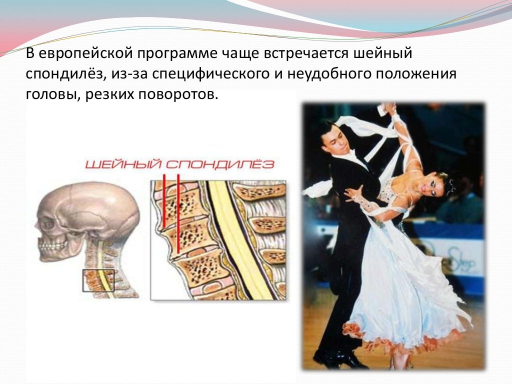 Спондилез поясничного отдела позвоночника