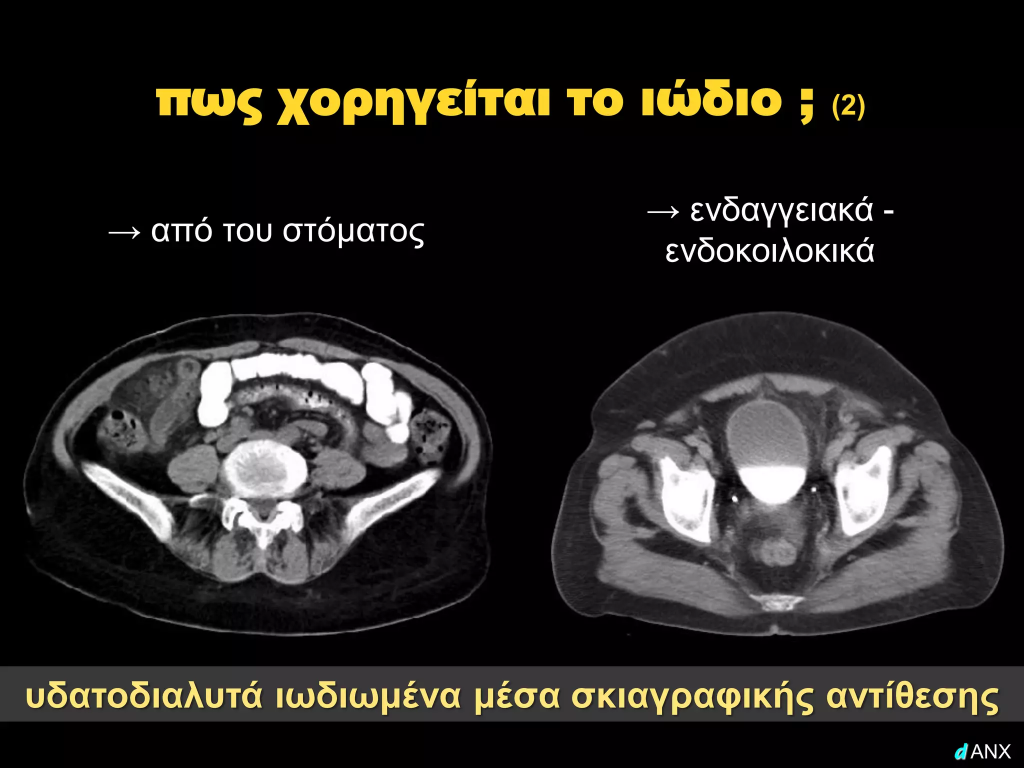 πως χορηγείται το ιώδιο ;           (2)


                               → ενδαγγειακά -
    → από του στόματος
                                ενδοκοιλοκικά




υδατοδιαλυτά ιωδιωμένα μέσα σκιαγραφικής αντίθεσης
                                                 d ANX
 