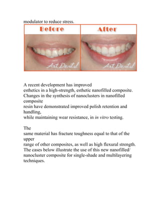 modulator to reduce stress.




A recent development has improved
esthetics in a high-strength, esthetic nanofilled composite.
Changes in the synthesis of nanoclusters in nanofilled
composite
resin have demonstrated improved polish retention and
handling,
while maintaining wear resistance, in in vitro testing.

The
same material has fracture toughness equal to that of the
upper
range of other composites, as well as high flexural strength.
The cases below illustrate the use of this new nanofilled/
nanocluster composite for single-shade and multilayering
techniques.
 