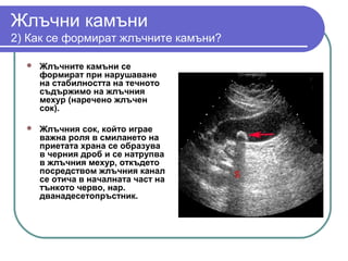 жлъчни камъни | PPT