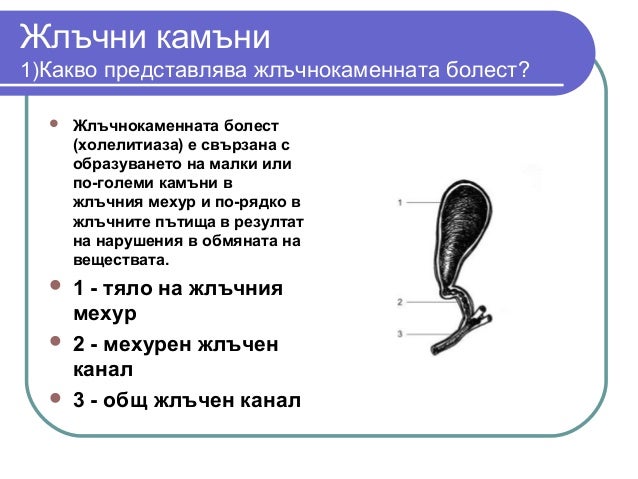 жлъчни камъни