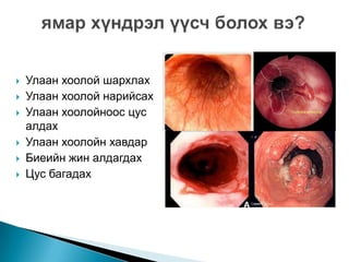 ходоод улаан хоолойн сөөргөө өвчин | PPT