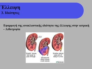 Έλλειψη
3. Ιδιότητες


 Εφαρμογή της ανακλαστικής ιδιότητα της έλλειψης στην ιατρική
 - Λιθοτριψία
 