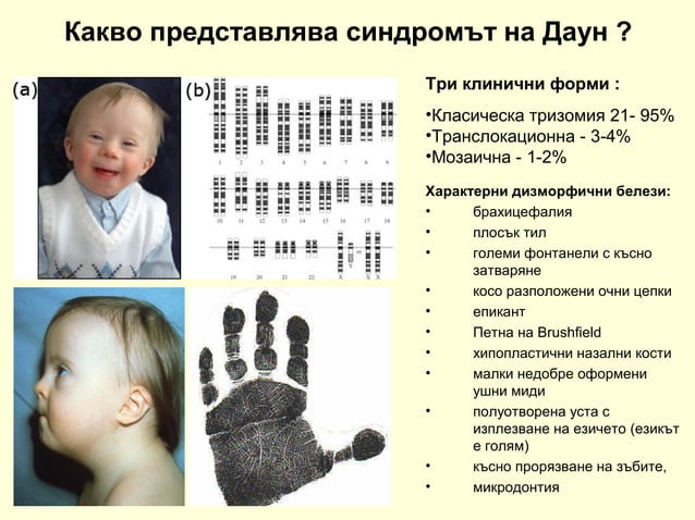 Синдром на Даун
