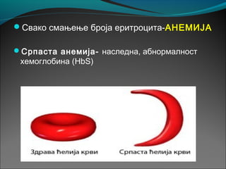 Свако смањење броја еритроцита-АНЕМИЈА
Српаста анемија- наследна, абнормалност
хемоглобина (HbS)
 