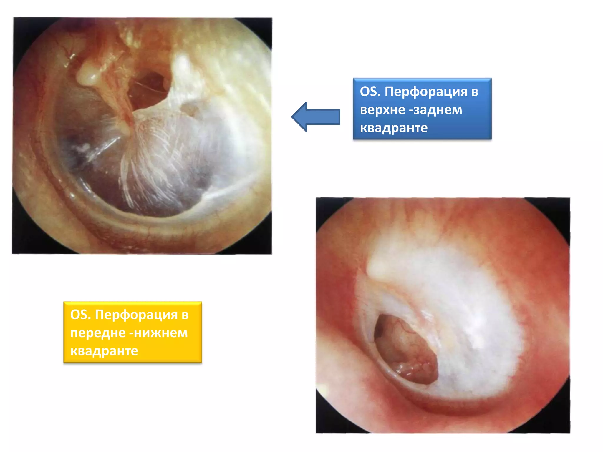 OS. Перфорация в
верхне -заднем
квадранте
OS. Перфорация в
передне -нижнем
квадранте
 
