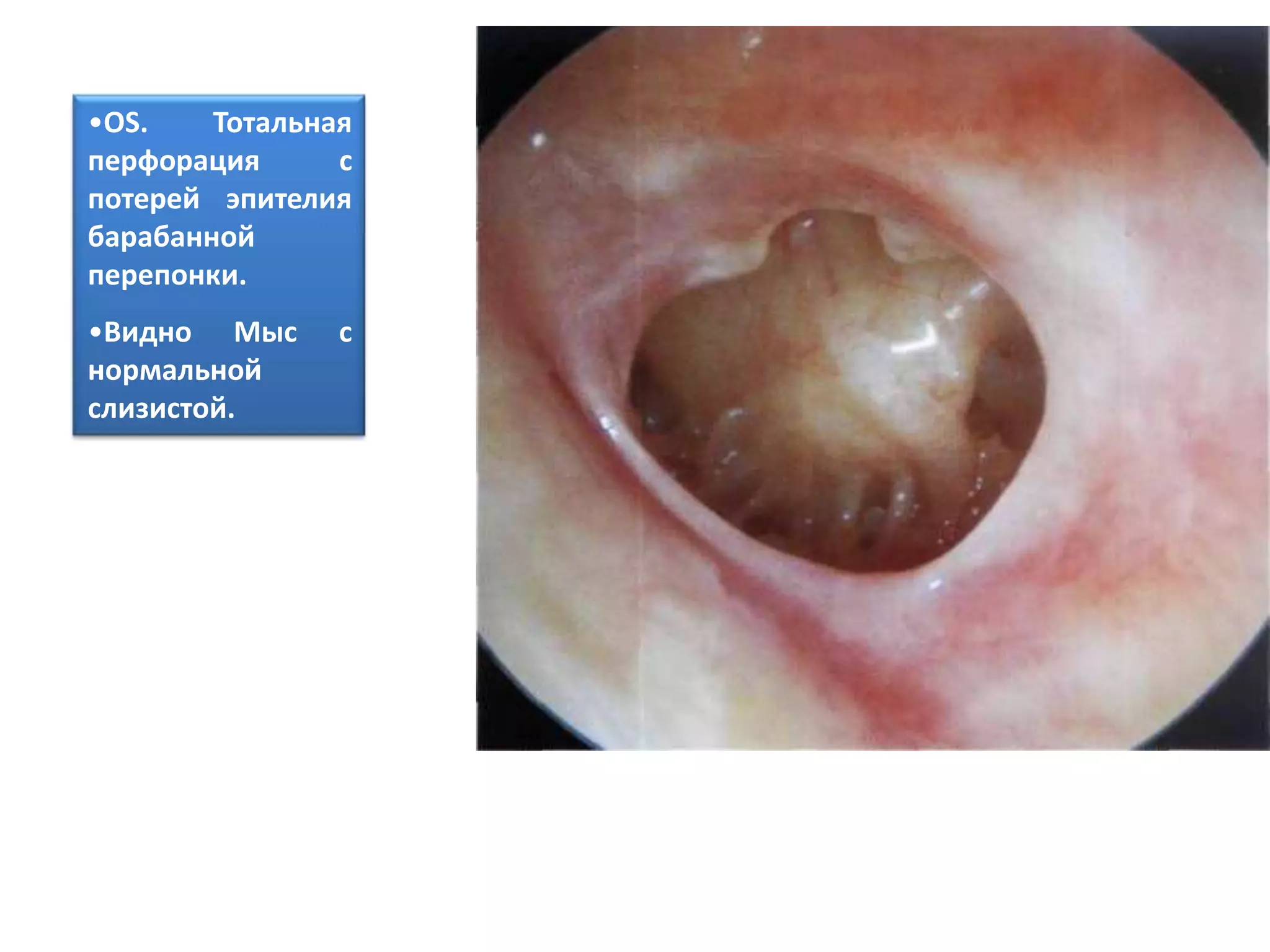 •OS. Тотальная
перфорация с
потерей эпителия
барабанной
перепонки.
•Видно Мыс с
нормальной
слизистой.
 