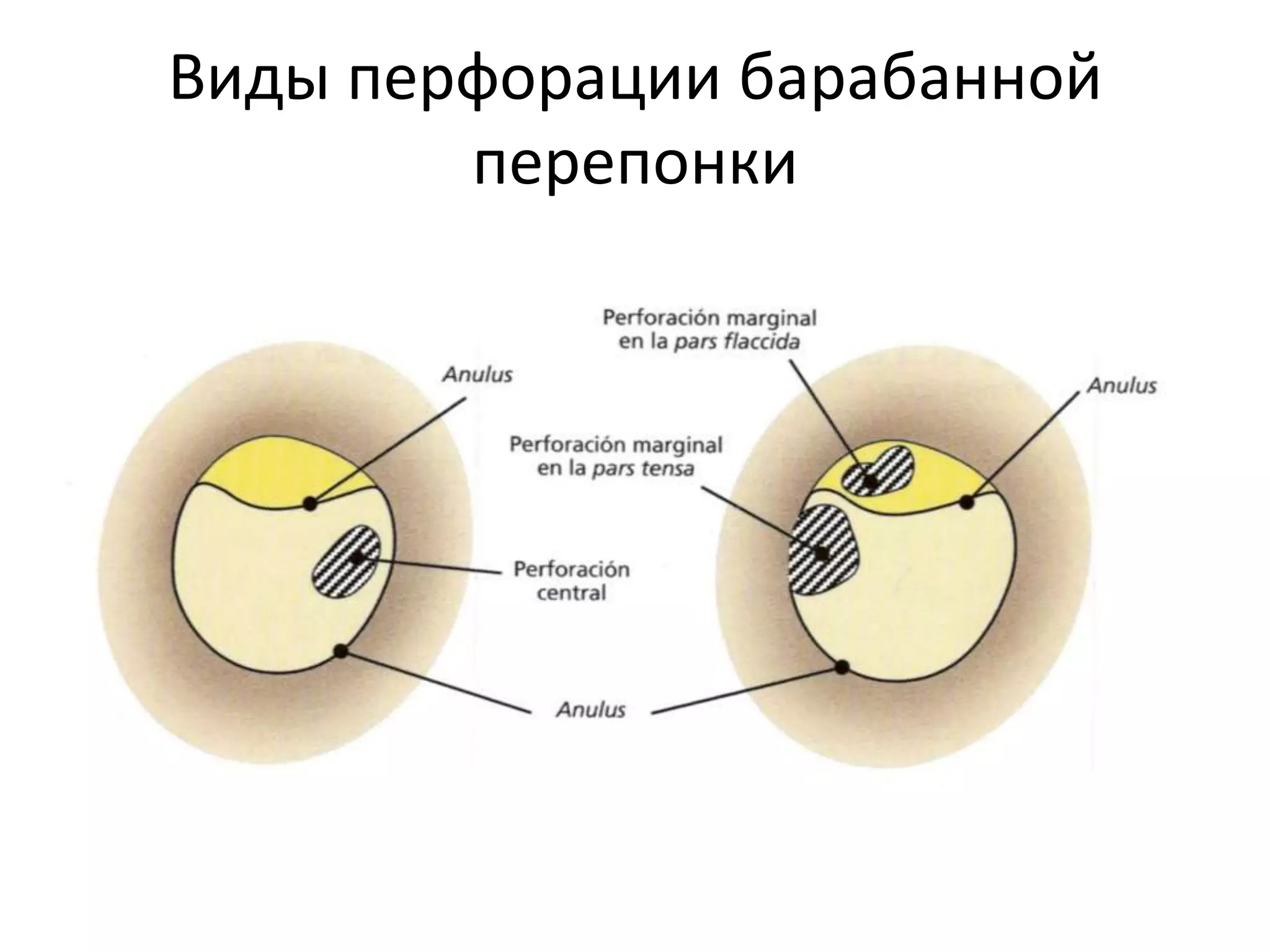 Виды перфорации барабанной
перепонки
 