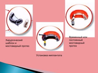 Хирургический
шаблон и
мостовидный протез
Установка имплантата
Временный или
постоянный
мостовидный
протез
 