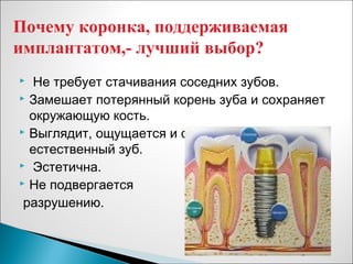  Не требует стачивания соседних зубов.
 Замешает потерянный корень зуба и сохраняет
окружающую кость.
 Выглядит, ощущается и функционирует как
естественный зуб.
 Эстетична.
 Не подвергается
разрушению.
Почему коронка, поддерживаемая
имплантатом,- лучший выбор?
 