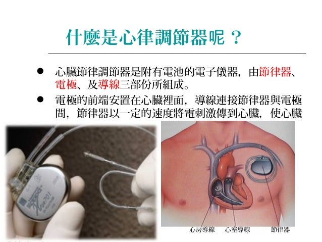 心律調節器重大傷病 James Briggs