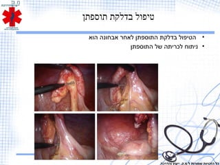 ‫תוספתן‬ ‫בדלקת‬ ‫טיפול‬
•‫הוא‬ ‫אבחונה‬ ‫לאחר‬ ‫התוספתן‬ ‫בדלקת‬ ‫הטיפול‬
•‫התוספתן‬ ‫של‬ ‫לכריתה‬ ‫ניתוח‬
‫והדרכה‬ ‫ייעוץ‬ .‫מ.ק‬ ‫ל‬ ‫שמורות‬ ‫הזכויות‬ ‫כל‬
 