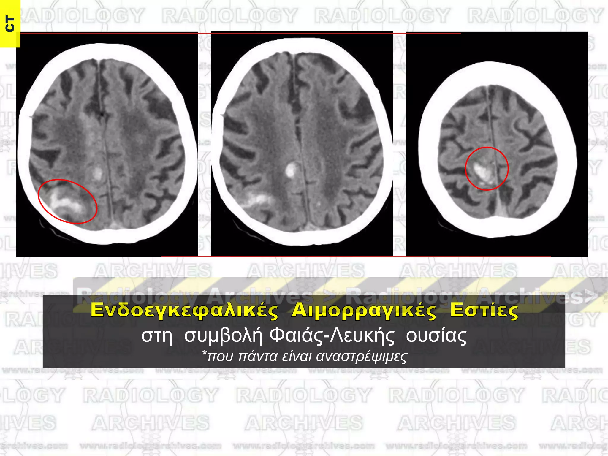ζηε ζπκβνιή Φαηάο-Λεπθήο νπζίαο
*ποσ πάνηα είναι αναζηρέψιμες
CT
 