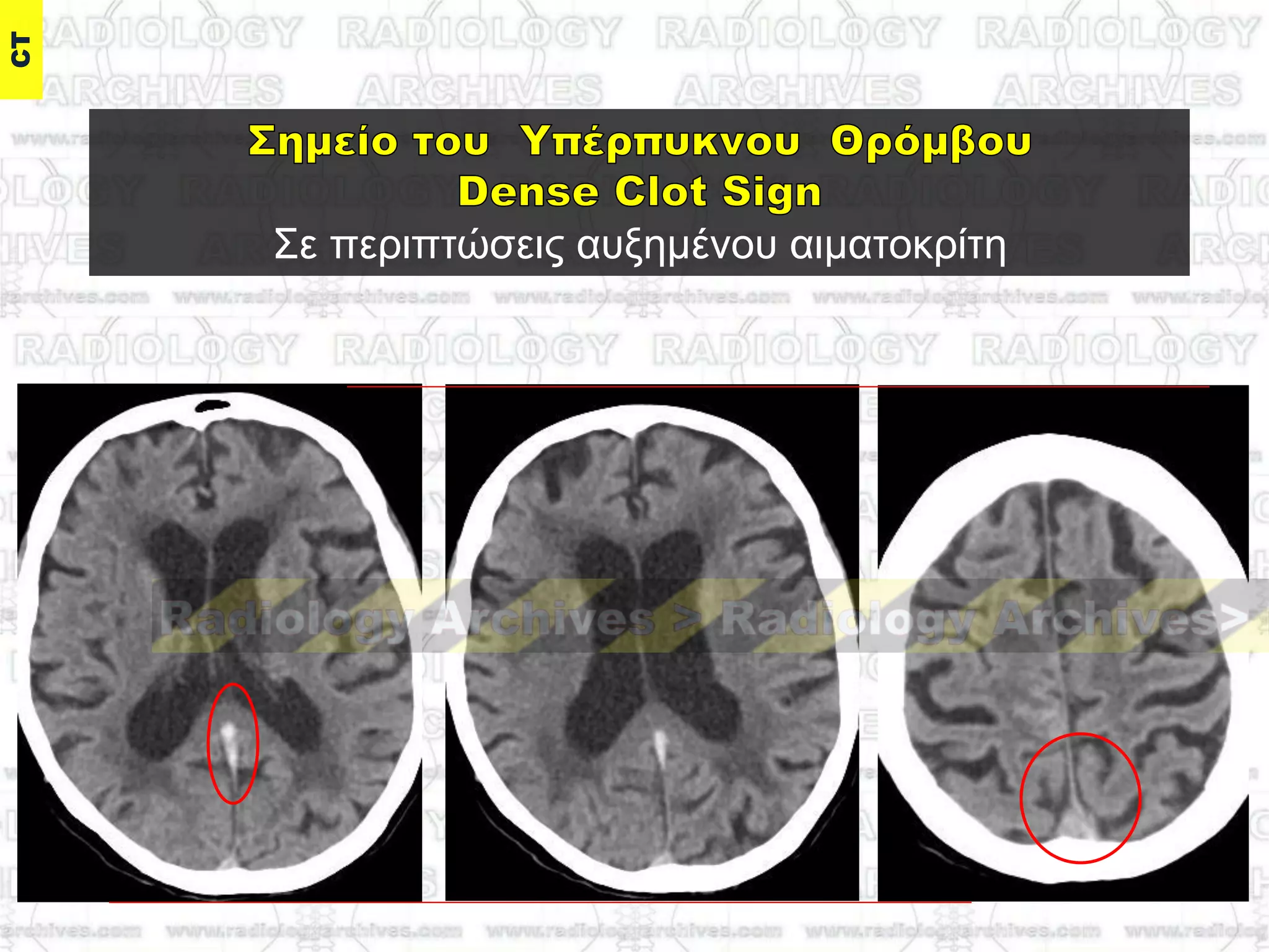 ΢ε πεξηπηώζεηο απμεκέλνπ αηκαηνθξίηε
 