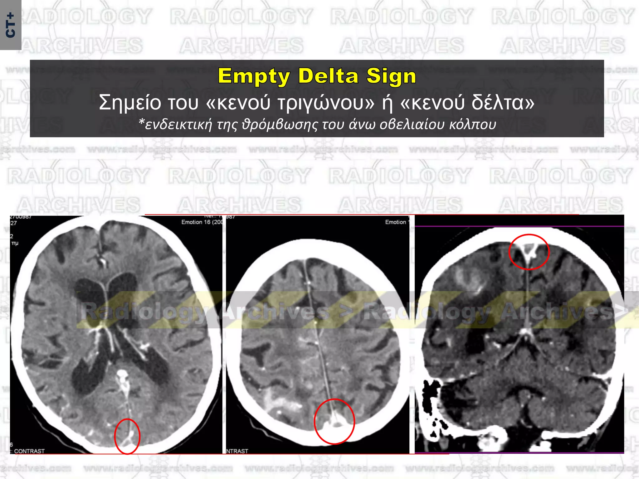 ΢εκείν ηνπ «θελνύ ηξηγώλνπ» ή «θελνύ δέιηα»
*ενδεικτική τησ θρόμβωςησ του άνω οβελιαίου κόλπου
CT+
 