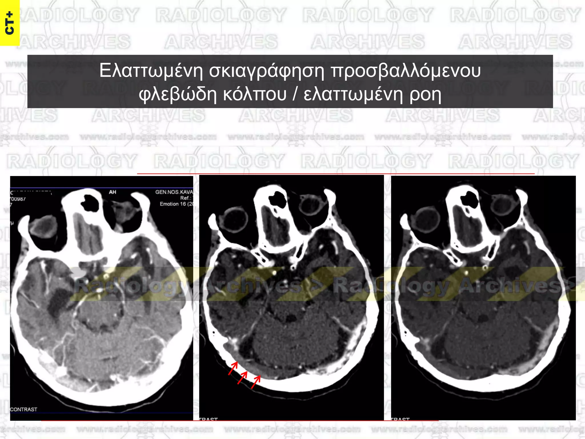 Διαηησκέλε ζθηαγξάθεζε πξνζβαιιόκελνπ
θιεβώδε θόιπνπ / ειαηησκέλε ξνε
 