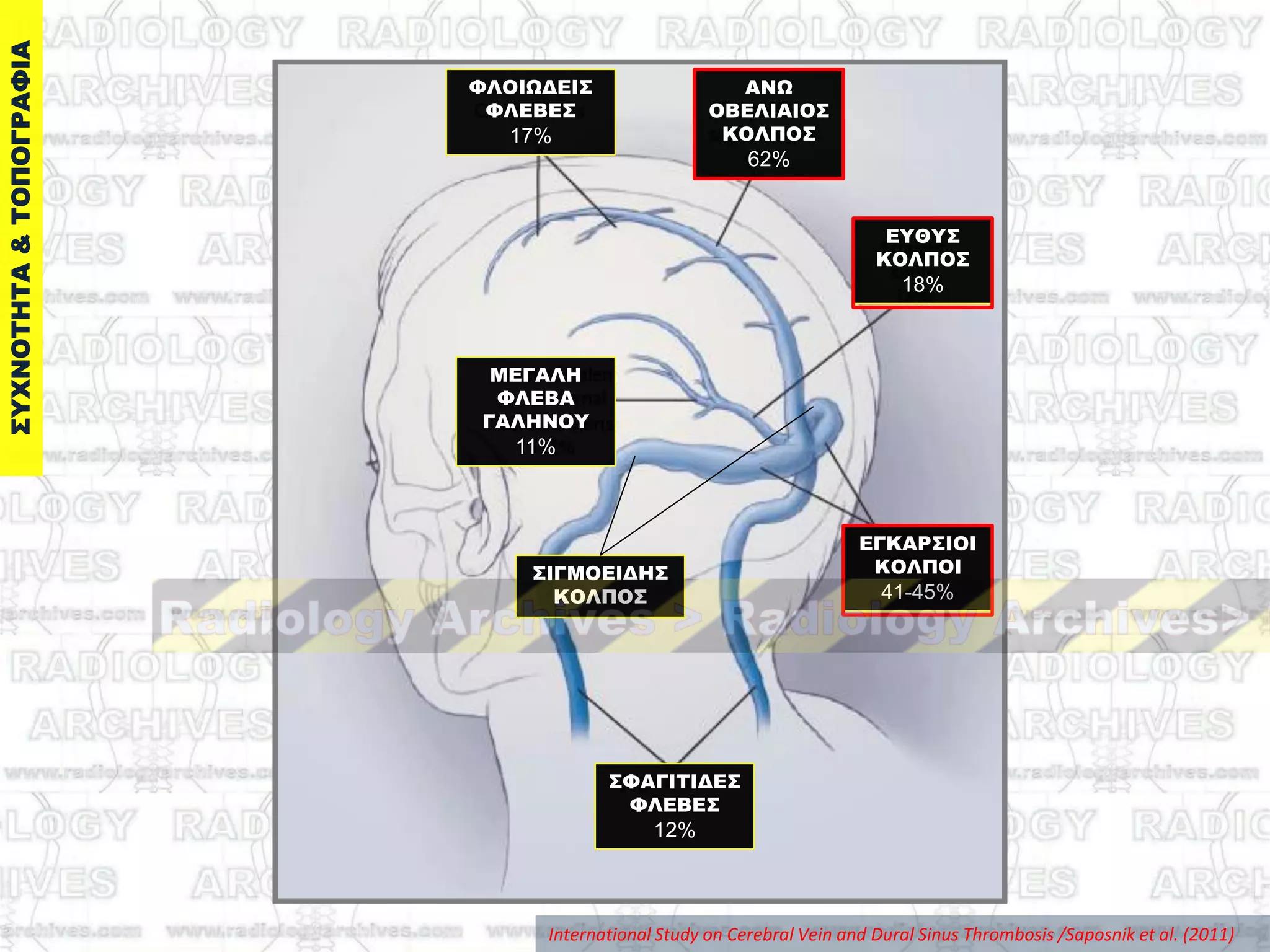 ΑΝΩ
ΟΒΕΛΙΑΙΟ΢
ΚΟΛΠΟ΢
62%
ΕΓΚΑΡ΢ΙΟΙ
ΚΟΛΠΟΙ
41-45%
΢ΥΑΓΙΣΙΔΕ΢
ΥΛΕΒΕ΢
12%
ΕΤΘΤ΢
ΚΟΛΠΟ΢
18%
ΜΕΓΑΛΗ
ΥΛΕΒΑ
ΓΑΛΗΝΟΤ
11%
ΥΛΟΙΩΔΕΙ΢
ΥΛΕΒΕ΢
17%
International Study on Cerebral Vein and Dural Sinus Thrombosis /Saposnik et al. (2011)
΢ΙΓΜΟΕΙΔΗ΢
ΚΟΛΠΟ΢
 