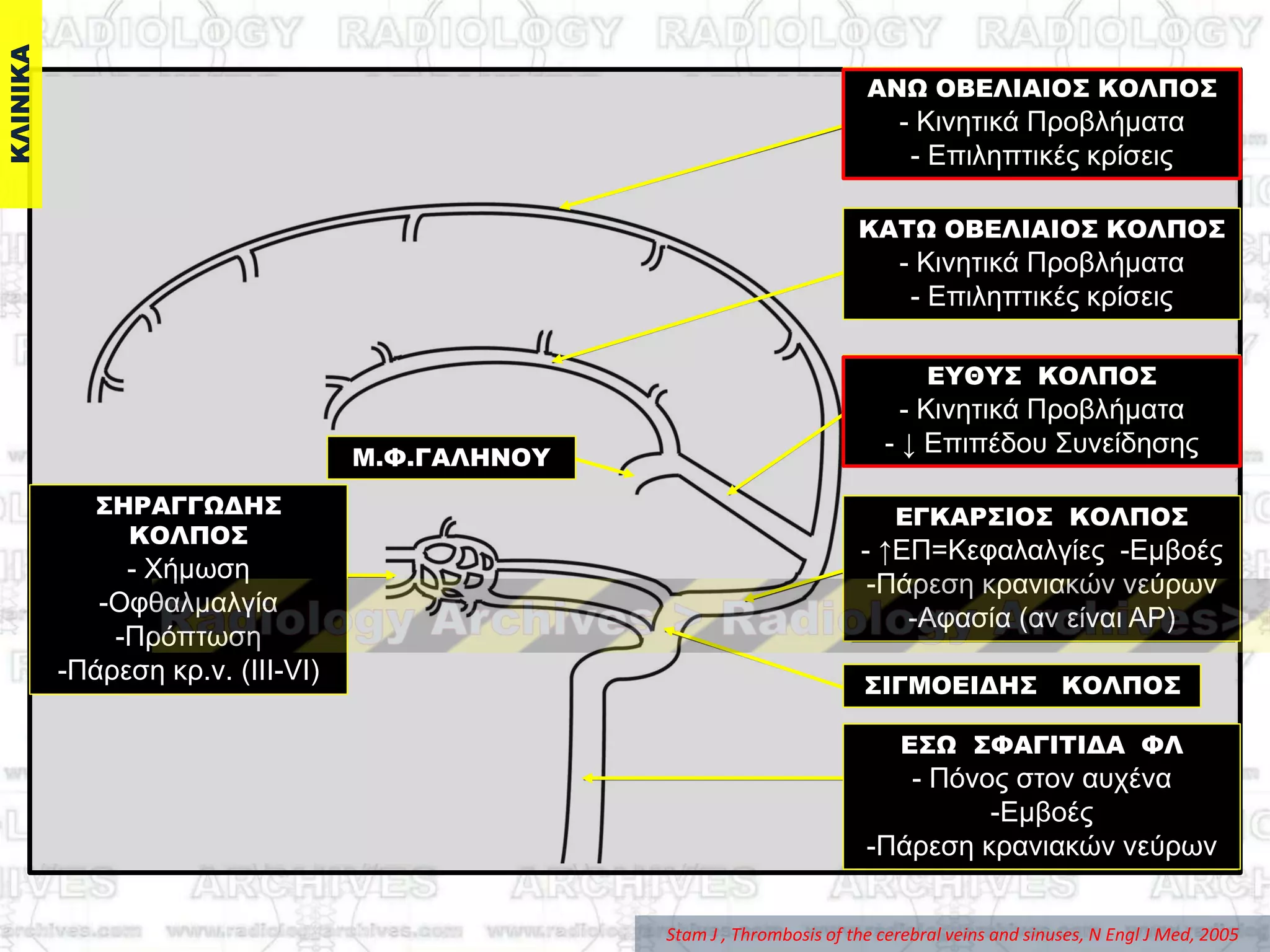Stam J , Thrombosis of the cerebral veins and sinuses, N Engl J Med, 2005
ΕΓΚΑΡ΢ΙΟ΢ ΚΟΛΠΟ΢
- ↑ΔΠ=Κεθαιαιγίεο -Δκβνέο
-Πάξεζε θξαληαθώλ λεύξσλ
-Αθαζία (αλ είλαη ΑΡ)
΢ΙΓΜΟΕΙΔΗ΢ ΚΟΛΠΟ΢
Ε΢Ω ΢ΥΑΓΙΣΙΔΑ ΥΛ
- Πόλνο ζηνλ απρέλα
-Δκβνέο
-Πάξεζε θξαληαθώλ λεύξσλ
ΚΑΣΩ ΟΒΕΛΙΑΙΟ΢ ΚΟΛΠΟ΢
- Κηλεηηθά Πξνβιήκαηα
- Δπηιεπηηθέο θξίζεηο
ΑΝΩ ΟΒΕΛΙΑΙΟ΢ ΚΟΛΠΟ΢
- Κηλεηηθά Πξνβιήκαηα
- Δπηιεπηηθέο θξίζεηο
ΕΤΘΤ΢ ΚΟΛΠΟ΢
- Κηλεηηθά Πξνβιήκαηα
- ↓ Δπηπέδνπ ΢πλείδεζεοΜ.Υ.ΓΑΛΗΝΟΤ
΢ΗΡΑΓΓΩΔΗ΢
ΚΟΛΠΟ΢
- Υήκσζε
-Οθζαικαιγία
-Πξόπησζε
-Πάξεζε θξ.λ. (ΗΗΗ-VI)
 