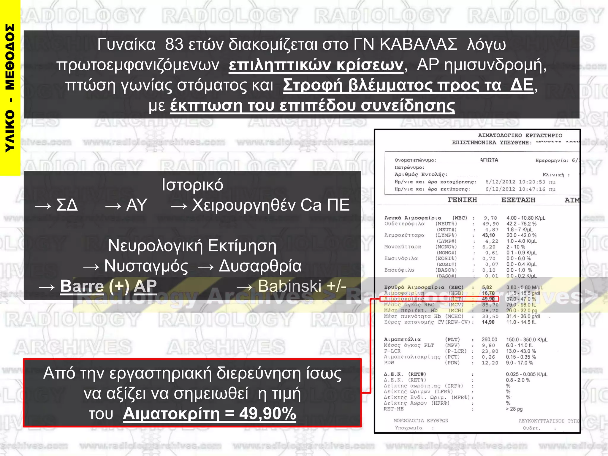 Ηζηνξηθό
→ ΢Γ → ΑΤ → Υεηξνπξγεζέλ Ca ΠΔ
Νεπξνινγηθή Δθηίκεζε
→ Νπζηαγκόο → Γπζαξζξία
→ Βarre (+) AΡ → Babinski +/-
Γπλαίθα 83 εηώλ δηαθνκίδεηαη ζην ΓΝ ΚΑΒΑΛΑ΢ ιόγσ
πξσηνεκθαληδόκελσλ επιληπηικών κπίζεων, ΑΡ εκηζπλδξνκή,
πηώζε γσλίαο ζηόκαηνο θαη ΢ηποθή βλέμμαηορ ππορ ηα ΓΔ,
κε έκπηωζη ηος επιπέδος ζςνείδηζηρ
Από ηελ εξγαζηεξηαθή δηεξεύλεζε ίζσο
λα αμίδεη λα ζεκεησζεί ε ηηκή
ηνπ Αιμαηοκπίηη = 49,90%
 