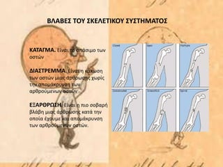 ΒΛΑΒΕΣ ΤΟΥ ΣΚΕΛΕΤΙΚΟΥ ΣΥΣΤΗΜΑΤΟΣ
ΚΑΤΑΓΜΑ. Είναι το σπάσιμο των
οστών
ΔΙΑΣΤΡΕΜΜΑ. Είναι η κάκωση
των οστών μιας άρθρωσης χωρίς
την απομάκρυνση των
αρθρούμενων οστών
ΕΞΑΡΘΡΩΣΗ. Είναι η πιο σοβαρή
βλάβη μιας άρθρωσης κατά την
οποία έχουμε και απομάκρυνση
των αρθρούμενων οστών.
 