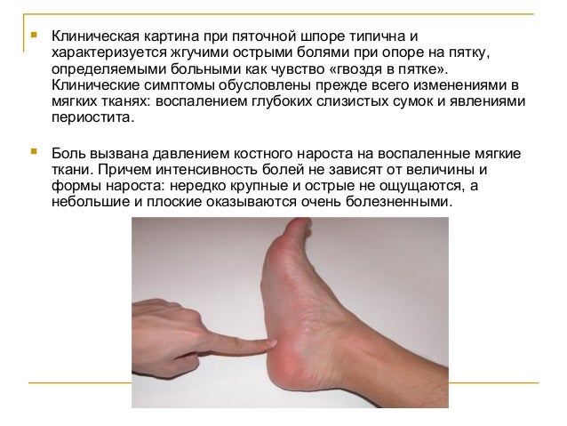 Шпоры на пятках лечение Пяточная шпора Как лечить шпоры