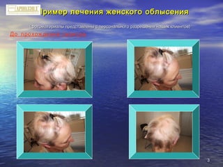 33
Пример лечения женского облысенияПример лечения женского облысения
(фотоматериалы представлены с персонального разрешения наших клиентов)(фотоматериалы представлены с персонального разрешения наших клиентов)
До прохождения сеансов
 