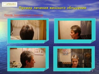 44
Пример лечения женского облысенияПример лечения женского облысения
После прохождения сеансов
 