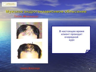 66
Мужское андрогензависимое облысениеМужское андрогензависимое облысение
10После процедур
2Через месяца
В настоящее время
клиент проходит
очередной
курс
 