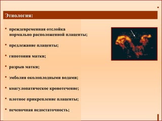 Этиология:
 преждевременная отслойка
нормально расположенной плаценты;
 предлежание плаценты;
 гипотония матки;
 разрыв матки;
 эмболия околоплодными водами;
 коагулопатическое кровотечение;
 плотное прикрепление плаценты;
 печеночная недостаточность;
 