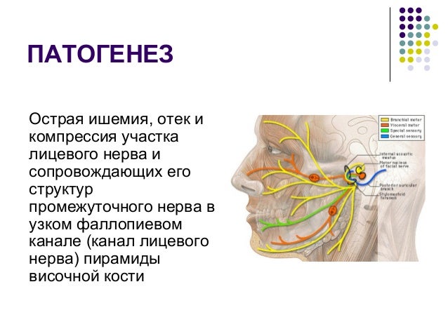 Множественная моторная невропатия
