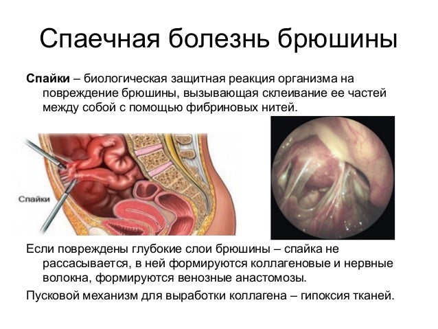 что такое спайки кишечника фото что такое спайки кишечника фото