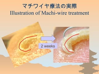 ޥ磻䯟ΌgH
Illustration of Machi-wire treatment
2 weeks
 
