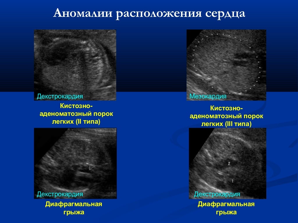 Синдром киммерли рентген. Аномалия киммерли в шейном отделе позвоночника рентген. Неполная аномалия кимерли. Аномалия швах. Синдром киммерли рентген.