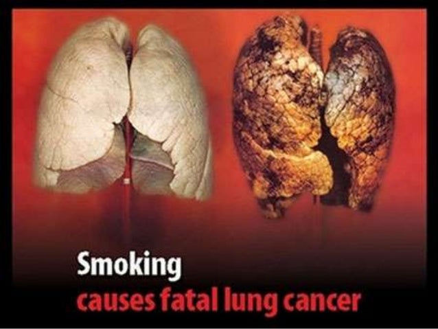 До тютюнового диму входять тисячі
шкідливих речовин та хімічних сполук:
нікотин, миш'як, свинець, ацетил, бензол,
ціанід, ...