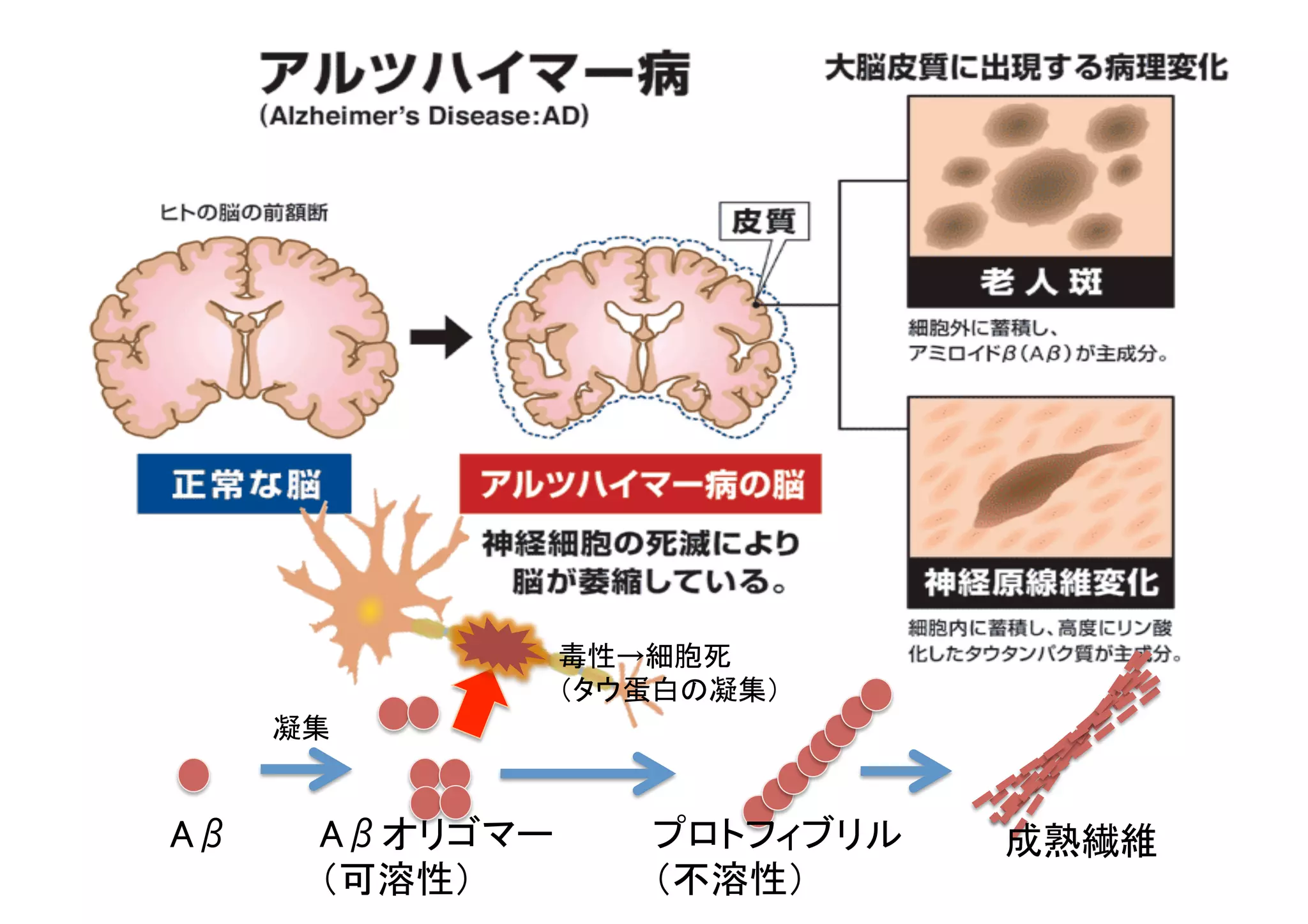 Aβ	
 Aβオリゴマー	
（可溶性）	
プロトフィブリル	
（不溶性）	
成熟繊維	
凝集	
毒性→細胞死	
（タウ蛋白の凝集）	
 