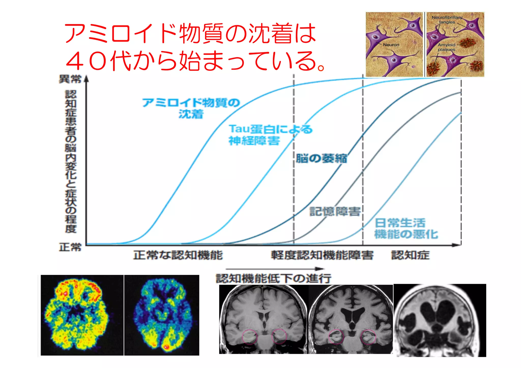 アミロイド物質の沈着は
４０代から始まっている。
 